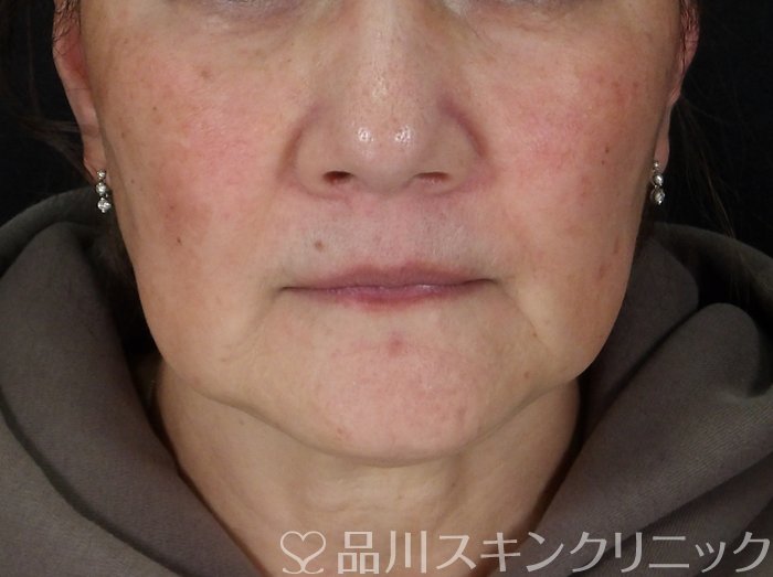 症例NO.72608のBEFORE写真