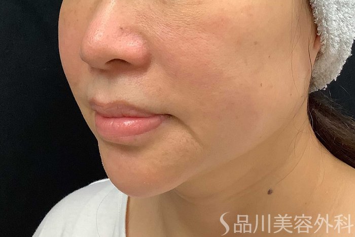 症例NO.69917のBEFORE写真