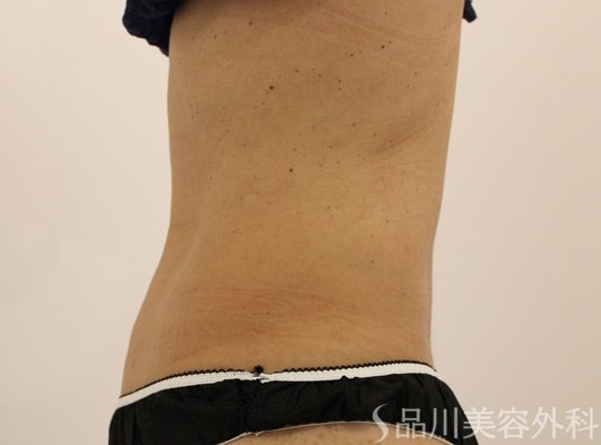 症例NO.73112のAFTER写真