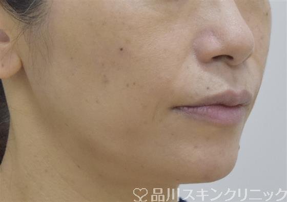 症例NO.53406のBEFORE写真