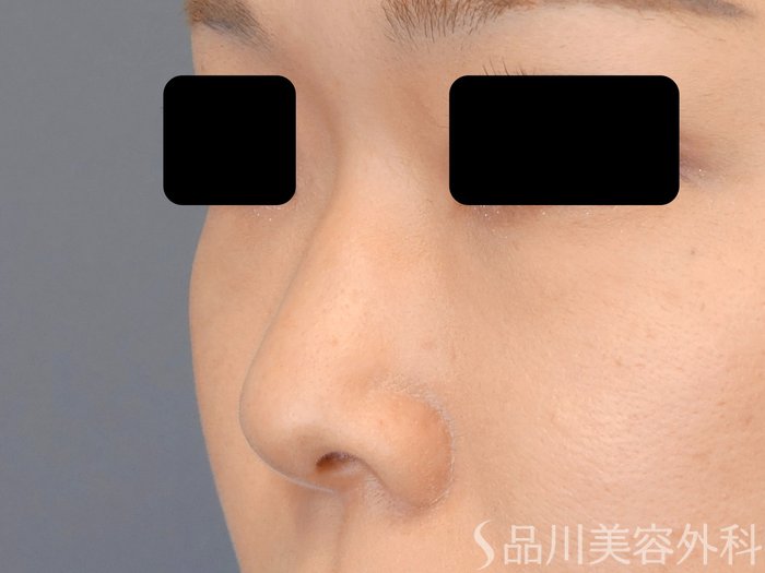 症例NO.70928のBEFORE写真