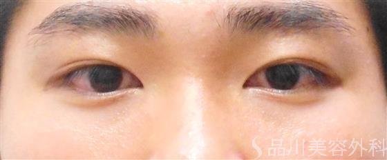 症例NO.43395のBEFORE写真