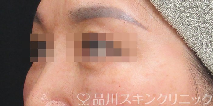 症例NO.72992のAFTER写真