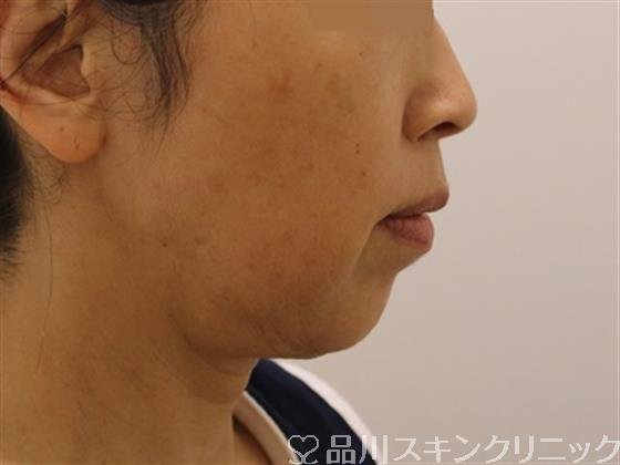 症例NO.43557のBEFORE写真