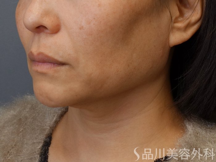 症例NO.72650のBEFORE写真