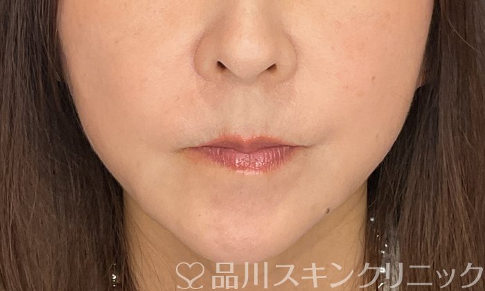 症例NO.74510のAFTER写真