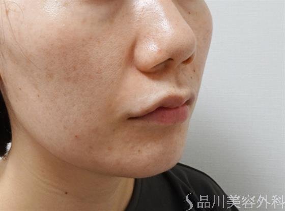 症例NO.51905のAFTER写真