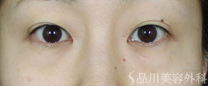 症例NO.69753のBEFORE写真