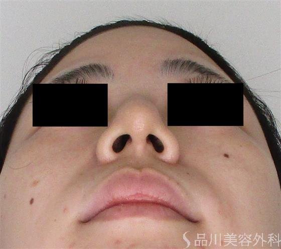 症例NO.59198のAFTER写真