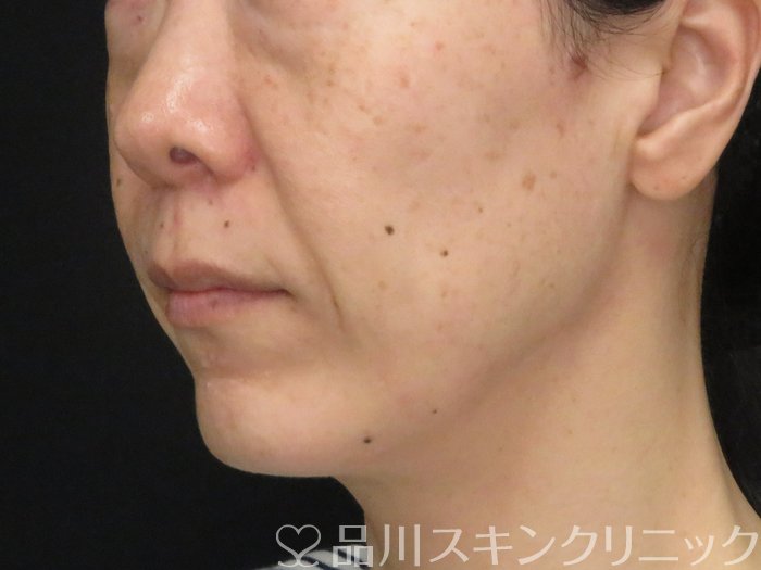 症例NO.69754のBEFORE写真