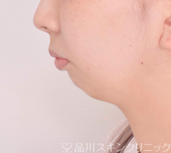 症例NO.69318のBEFORE写真