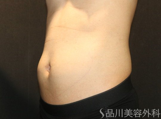 症例NO.70324のBEFORE写真