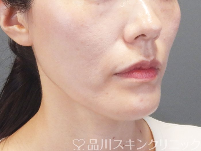 症例NO.75242のAFTER写真