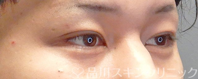 症例NO.74756のAFTER写真