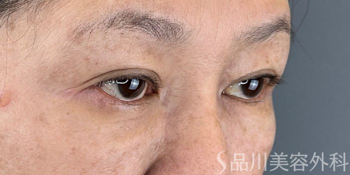 症例NO.70958のBEFORE写真