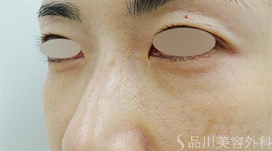 症例NO.49211のAFTER写真