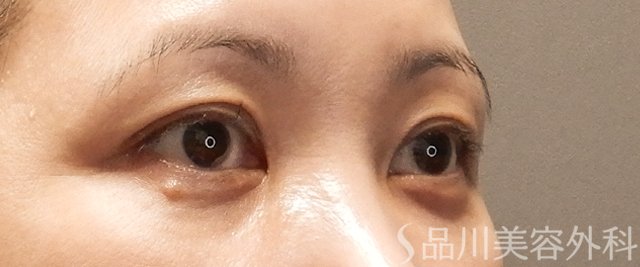 症例NO.72121のAFTER写真