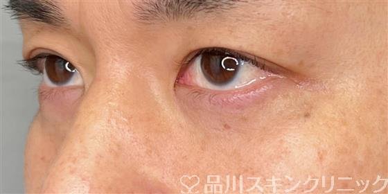 症例NO.55476のAFTER写真
