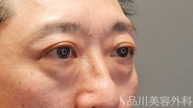 症例NO.74560のBEFORE写真