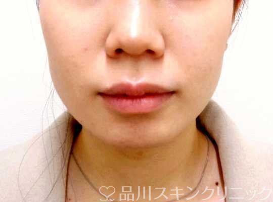 症例NO.69194のBEFORE写真