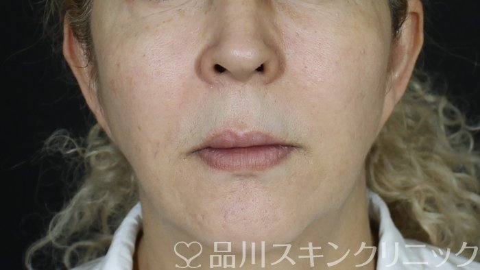 症例NO.72001のBEFORE写真