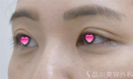 症例NO.52152のAFTER写真