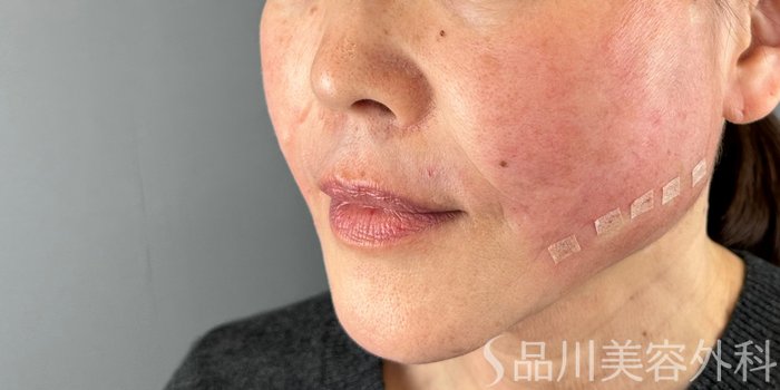 症例NO.73141のAFTER写真