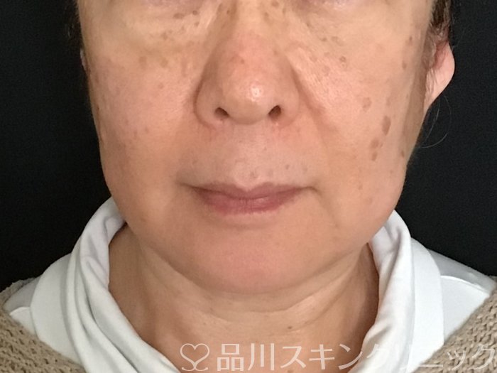 症例NO.65167のBEFORE写真