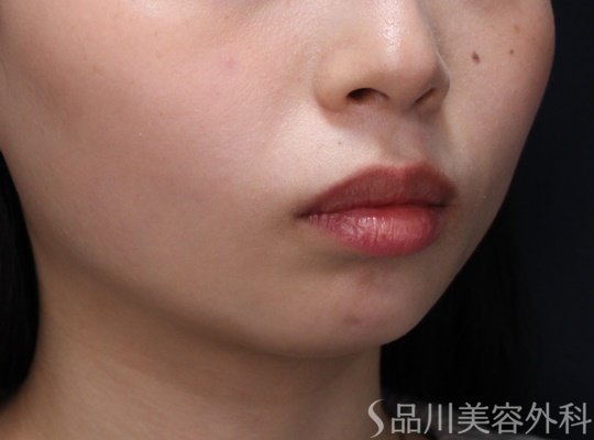 症例NO.69457のAFTER写真