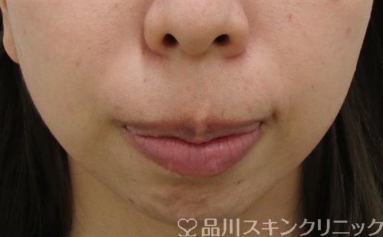 症例NO.39635のBEFORE写真