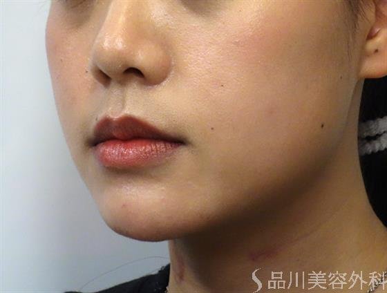 症例NO.40178のBEFORE写真