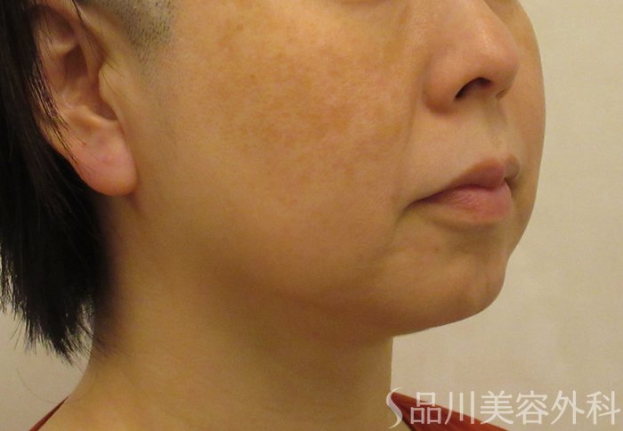 症例NO.71377のBEFORE写真