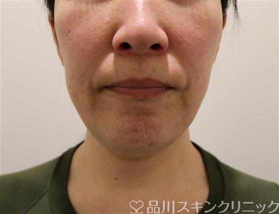 症例NO.40782のAFTER写真