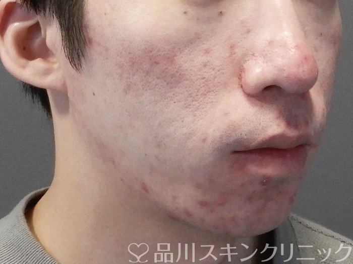 症例NO.69377のBEFORE写真