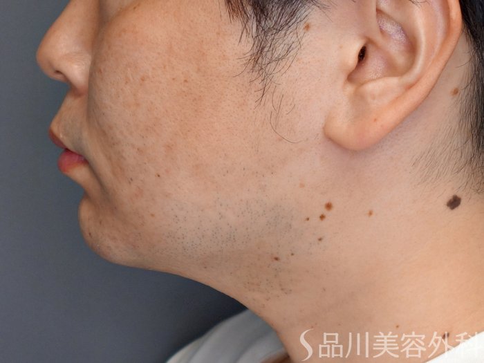 症例NO.73543のAFTER写真