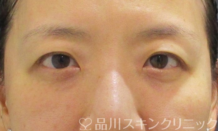 症例NO.67611のAFTER写真
