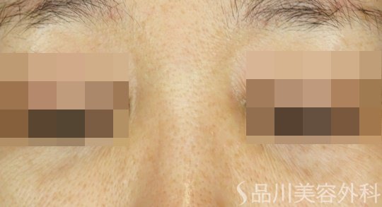 症例NO.67695のAFTER写真