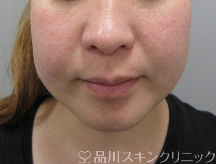 症例NO.69849のBEFORE写真