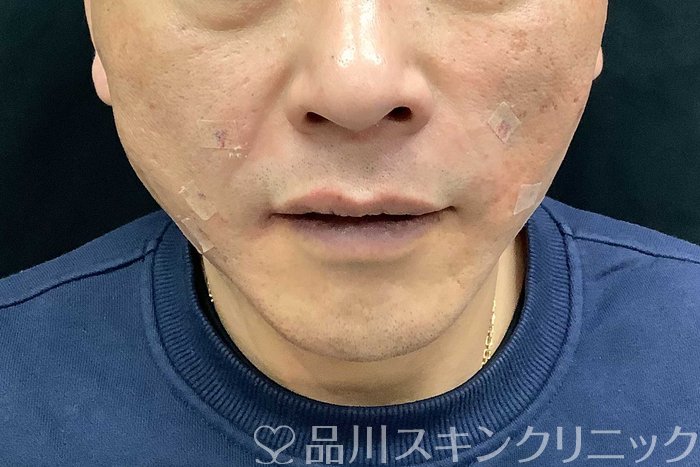 症例NO.69615のAFTER写真