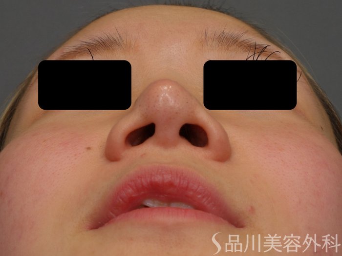 症例NO.73395のBEFORE写真