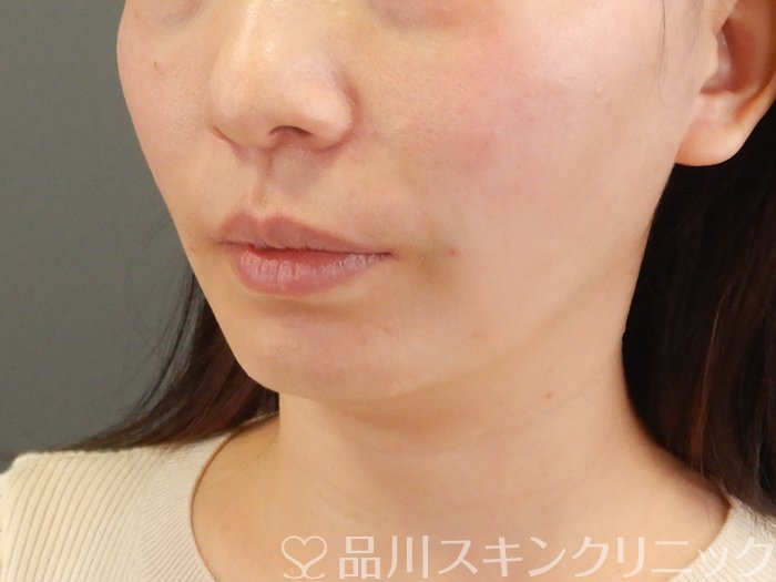 症例NO.63836のAFTER写真