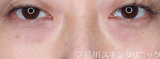 症例NO.59475のBEFORE写真