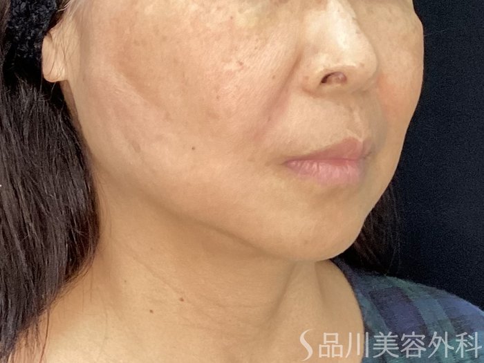 症例NO.71984のAFTER写真