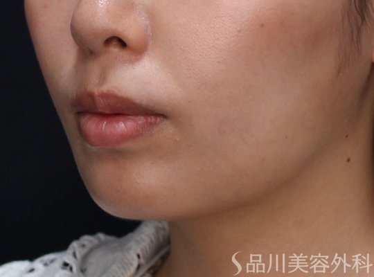 症例NO.73863のAFTER写真