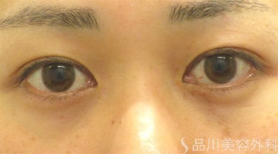 症例NO.40530のAFTER写真