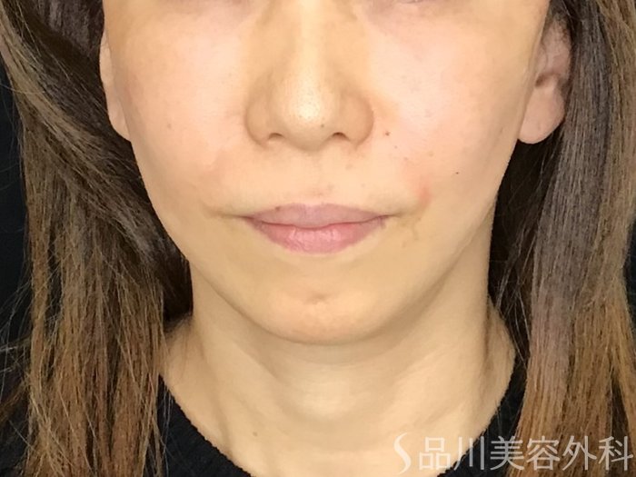 症例NO.69510のAFTER写真