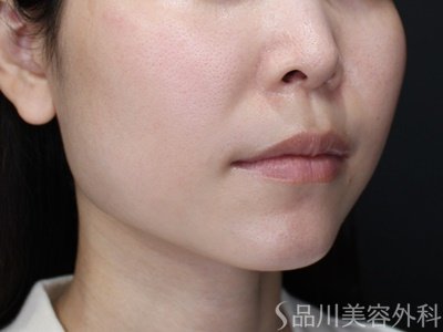 症例NO.72191のBEFORE写真