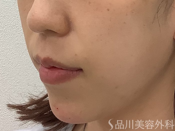 症例NO.67892のAFTER写真