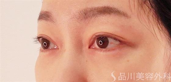 症例NO.58768のAFTER写真