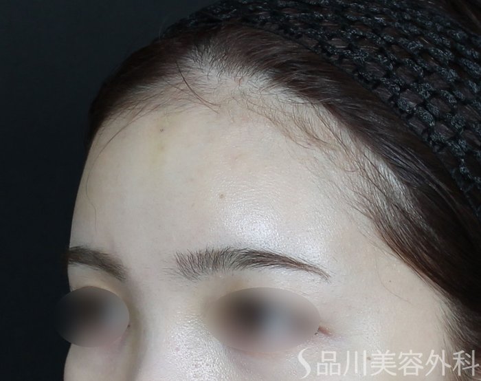 症例NO.73433のAFTER写真